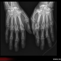 hémochromatose génétique: radiographie des mains